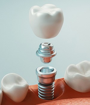A 3D rendering of the various parts of a dental implant