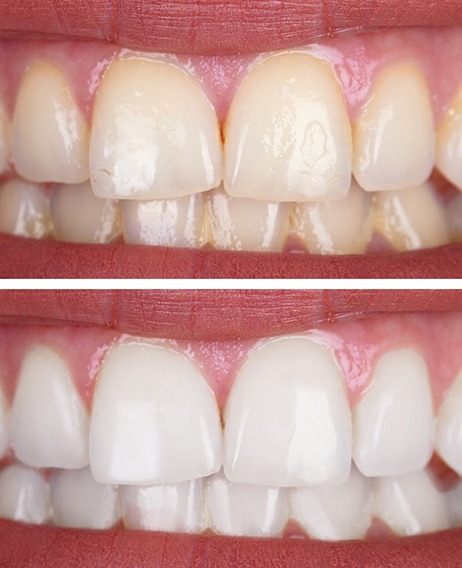 Close-up of person&rsquo;s smile before and after teeth whitening
