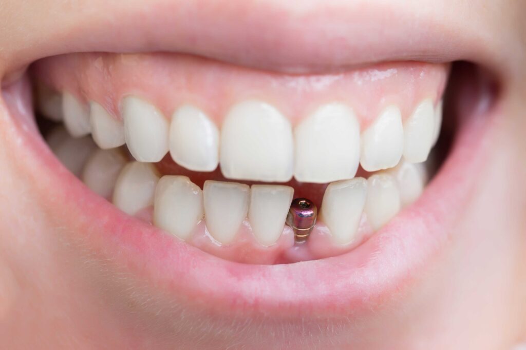 Closeup of dental implants